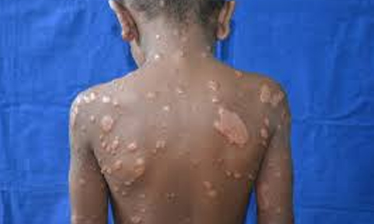 Awareness, social movement urgently needed to build a leprosy free society 