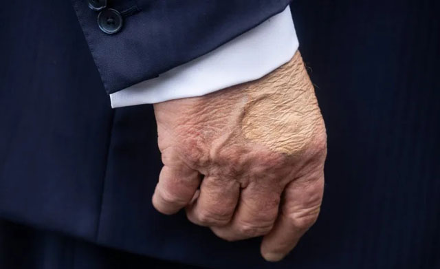 Trump diagnosed with vein issue after leg swelling, hand bruising