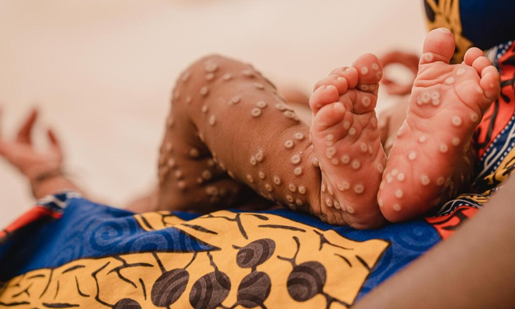 Guinea reports more than 200 mpox cases since first detection