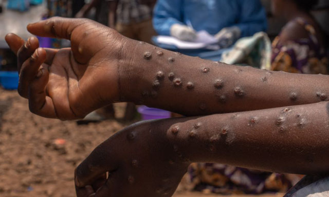 Gambia declares mpox outbreak