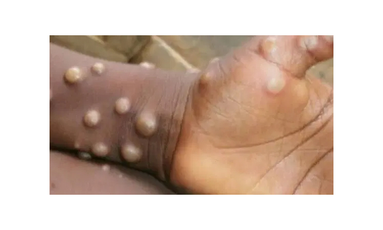 Ghana records first Mpox death as cases surge