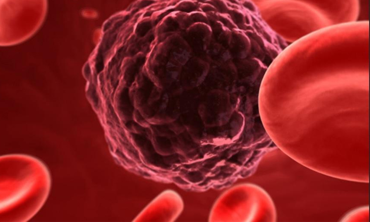 Liver cancer to double worldwide, most of it preventable: study