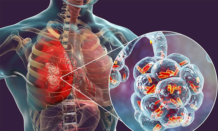 NYC Legionnaires' disease outbreak kills 5