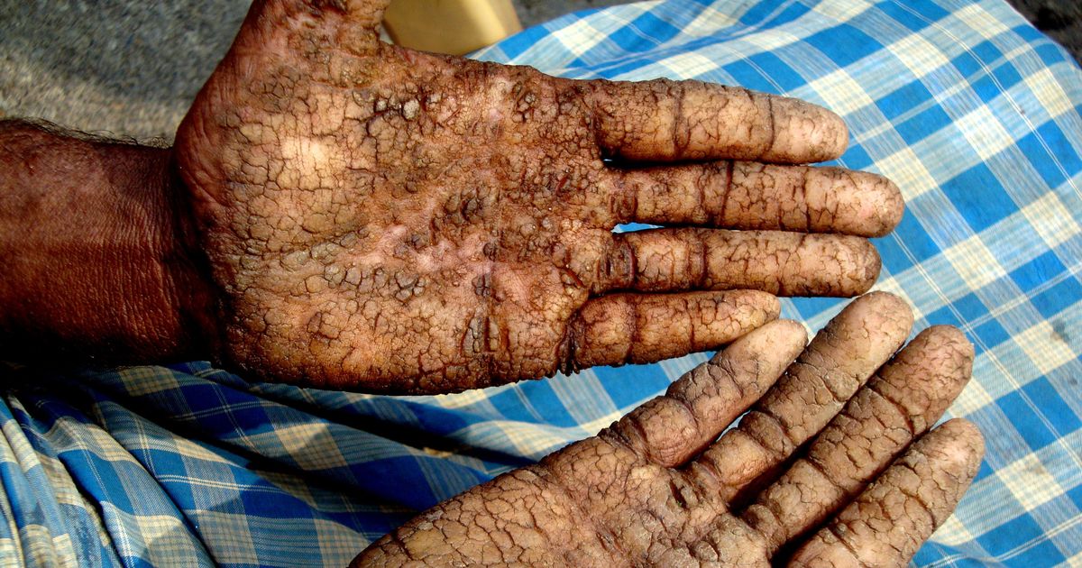 Arsenic in rice and vegetables; public health at risk