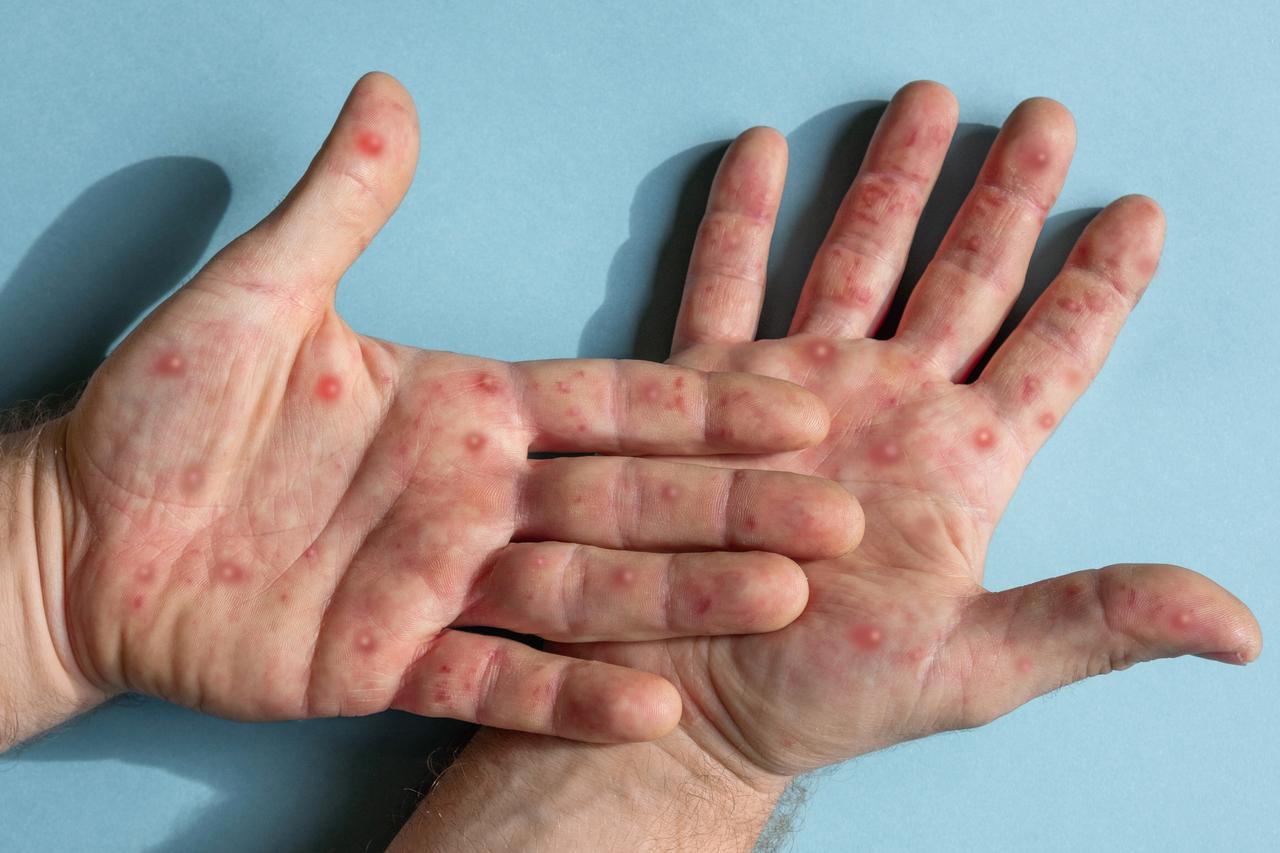 UK health agency identifies new mpox strain in England