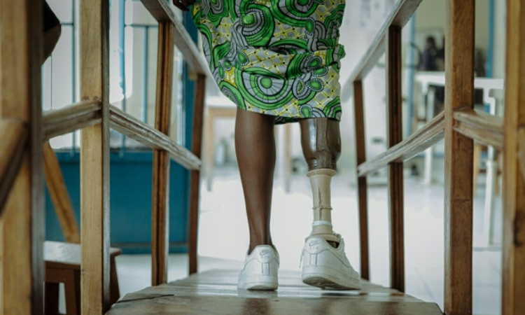 DR Congo's amputees bear scars of years of conflict