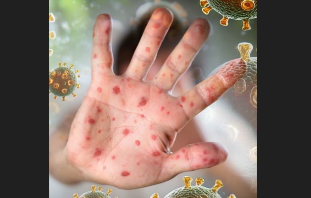 Two die with measles symptoms in Khulna division
