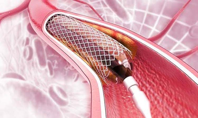 Heart ring price may drop by Tk 20,000 as VAT, taxes withdrawn