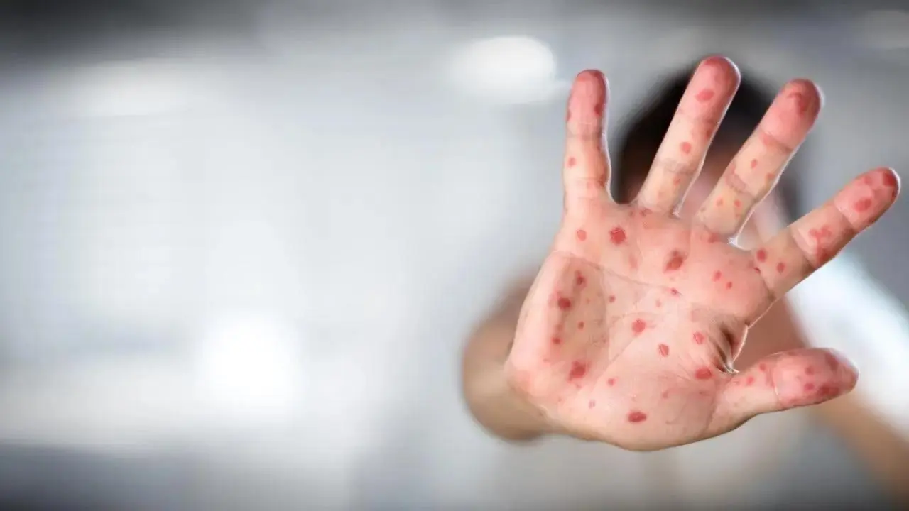 13 more children admitted to hospital with measles symptoms 