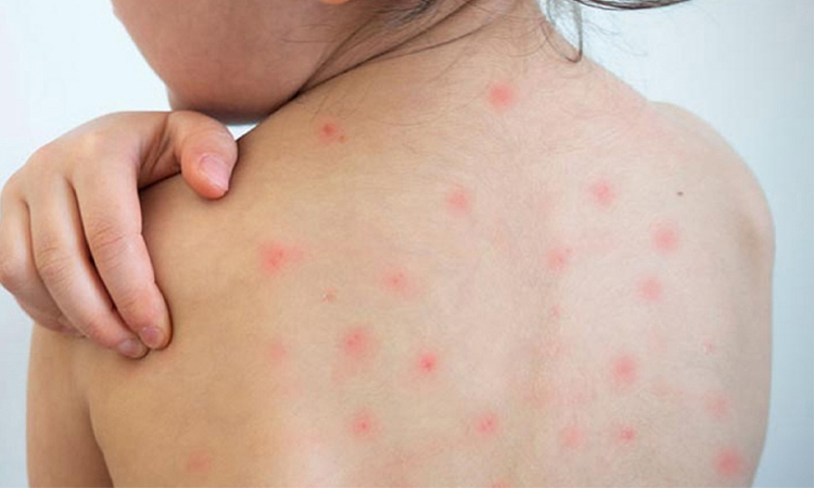 7 more die of suspected measles