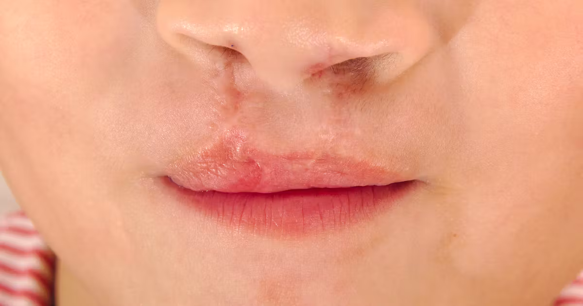Free surgery programme launched for children with cleft lip, palate